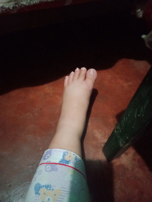 Mga mhiee normal ba ang pamamanas sa paa😔?