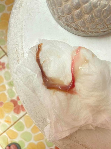 มูกสีน้ำตาลผสมสีชมพู