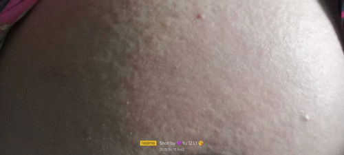 Bun mau tnya,ada GK yg lgi hamil skrg bawaan kulit merah n gatal sprti ini Bun ? Dksh apa Bun obt ny