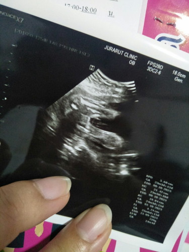 ภาพอัลตร้าซาวเพศหญิงมีสิทคลอดออกเปนชายไหม