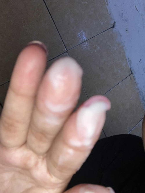 Keputihan saat hamil