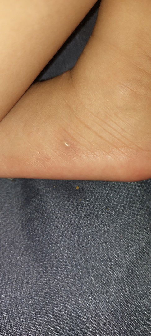 Benjolan di kulit bayi