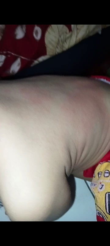 Anak merah merah di punggung