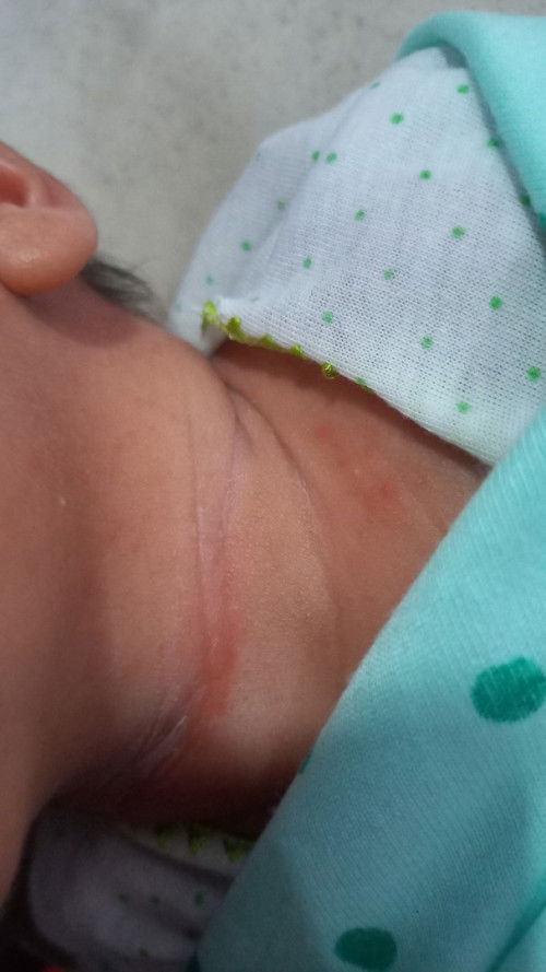 Ruam merah pada lipatan leher bayi 18 hari