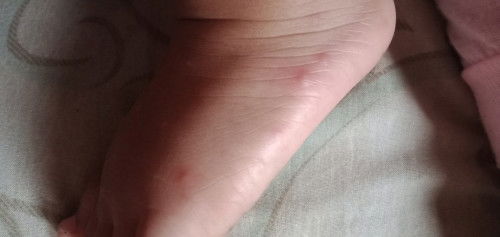 Anak tiba² rewel dan di bagian tubuh bentol