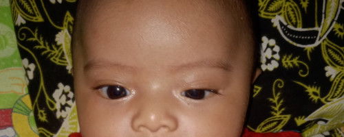 Kelopak mata anak berbeda