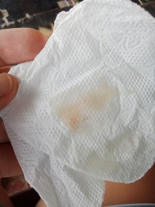 แบบนี้ตกขาวหรือมูกคะ