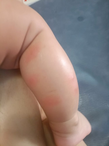 ลูกมีตุ่มเหมือนโดนยุงกัดค่ะ