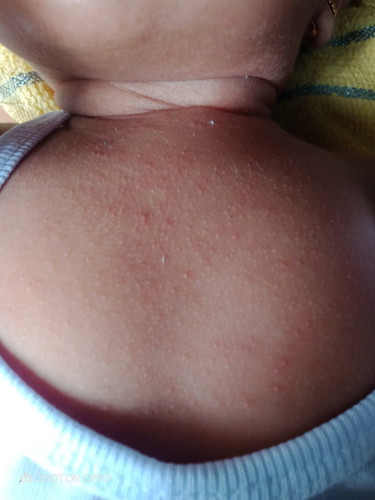Ano po itong mga rashes?