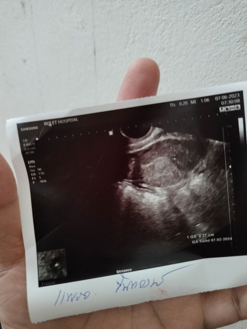 สรุปว่าท้องมั้ยคะ