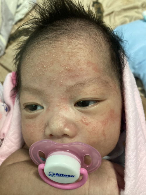 ลูกเป็นผื่นขึ้นหน้าค่ะ