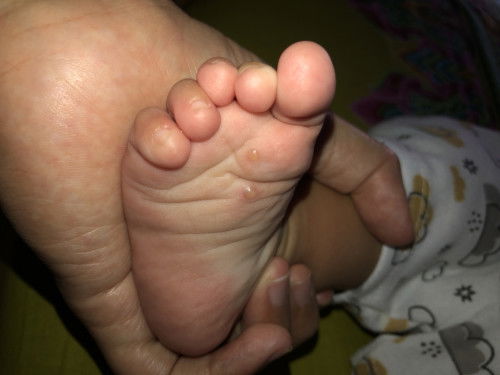 Bekas gigitan serangga