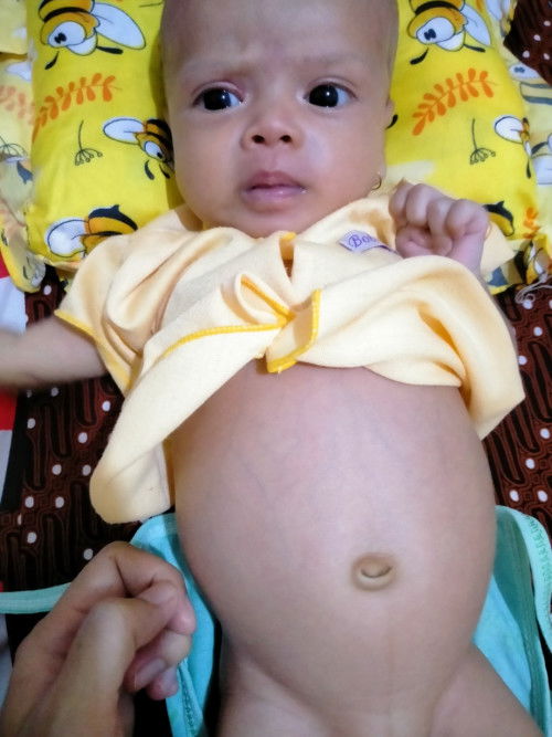 Bb tidak naik perut bayi besar