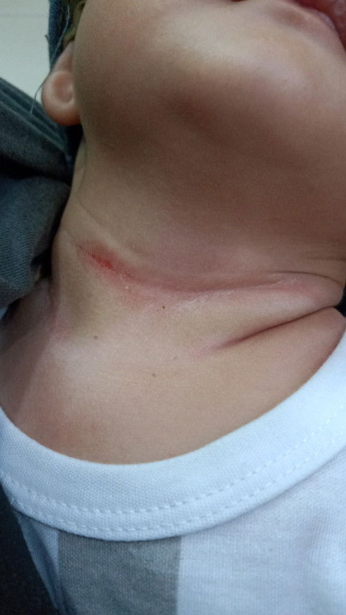 Leher merah kaya luka