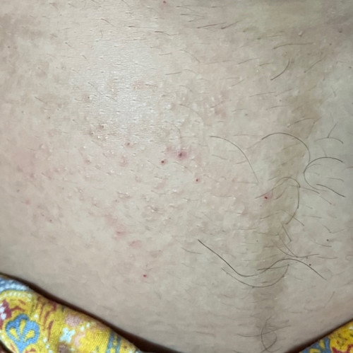 32W ท้องแรกมีแม่ๆบ้านไหนคันบริเวณใต้สะดือไหมค่ะ พอมีวิธีไม่ให้คัน แนะนำยาหน่อยค่ะ