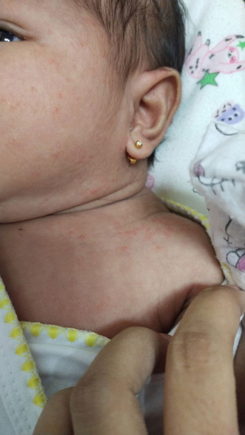 Rashes? Pano po mawala?