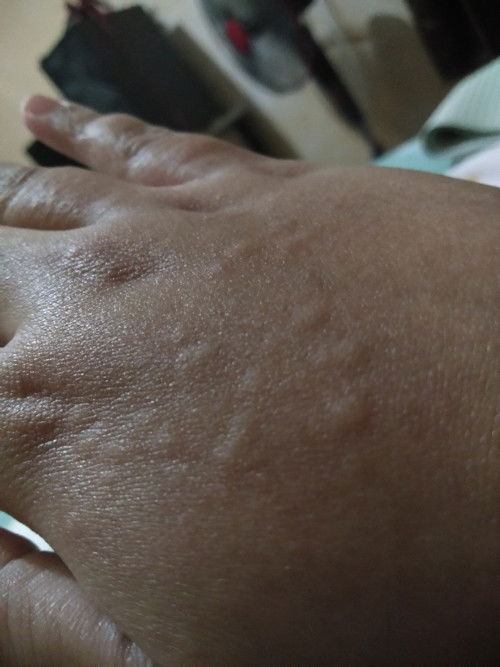 Alergi air pasca melahirkan