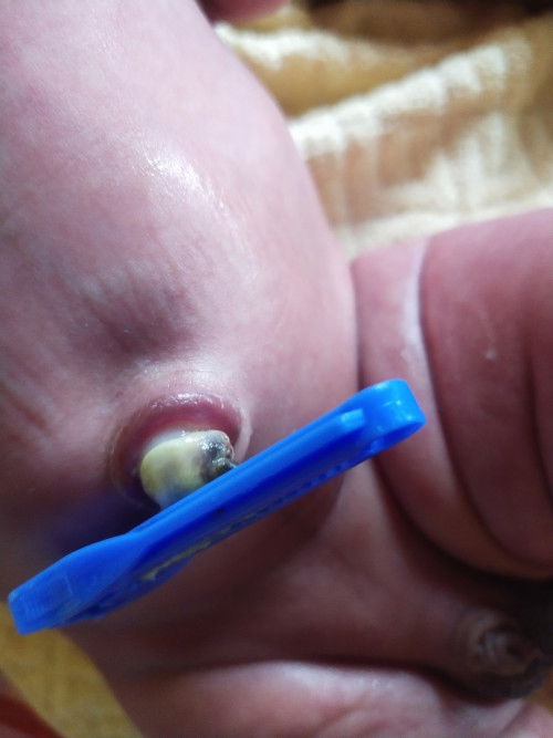 Tentang tali pusar bayi