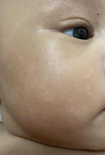 ลูก2เดือน หน้าเป็นจุดขาวๆแบบนี้