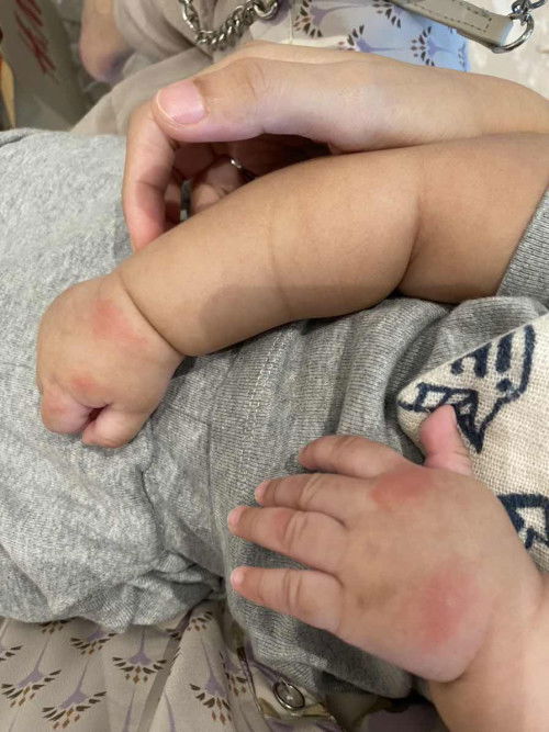 Tangan bentol bentol