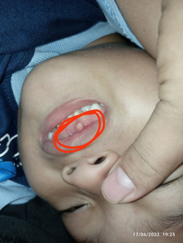 mau nanya bun...itu gusi anak ku knapa ya...baru engeh beberapa hari yg lalu...