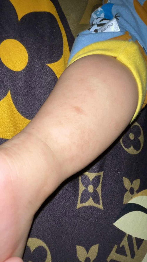 Bekas merah2 jd menghitam dan ha ilang2