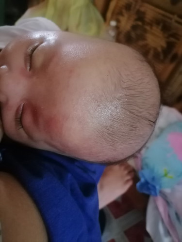 Alergy po ba ito? 1 month old baby