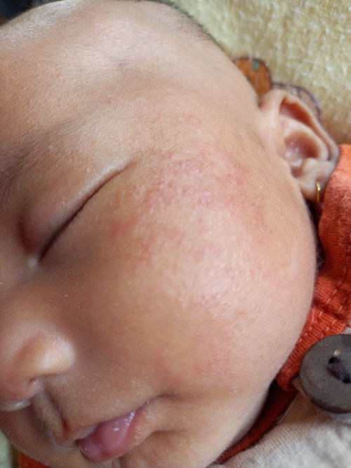 Pipi bayi memerah