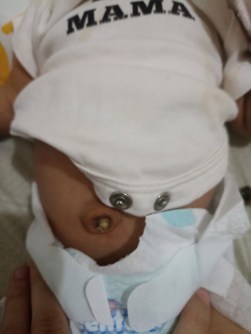 Normal po ba to natanggal na po Kasi pusod ni baby pero ganto po itsura niya