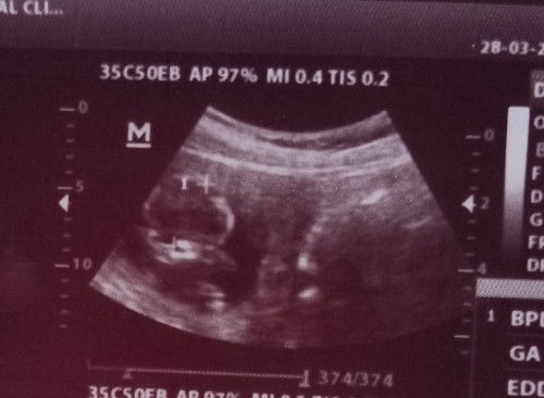 Ada dua kantong janin cuman janin nya yg kelihatan d USG cuman satu