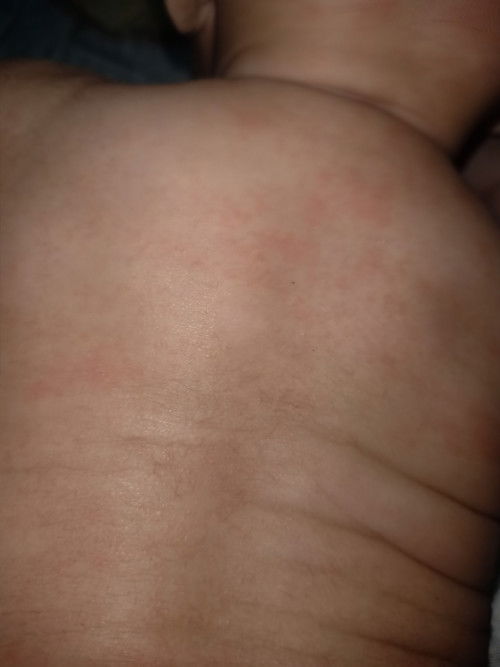 Kemerahan di seluruh badan