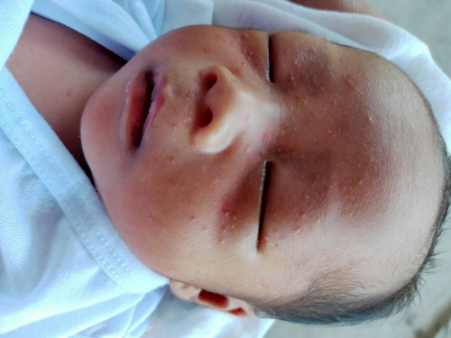Baby acne or rashes treatment