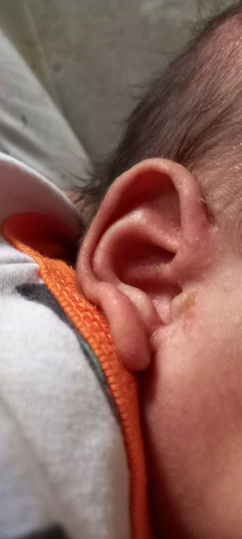 Telinga berkerak dan berair