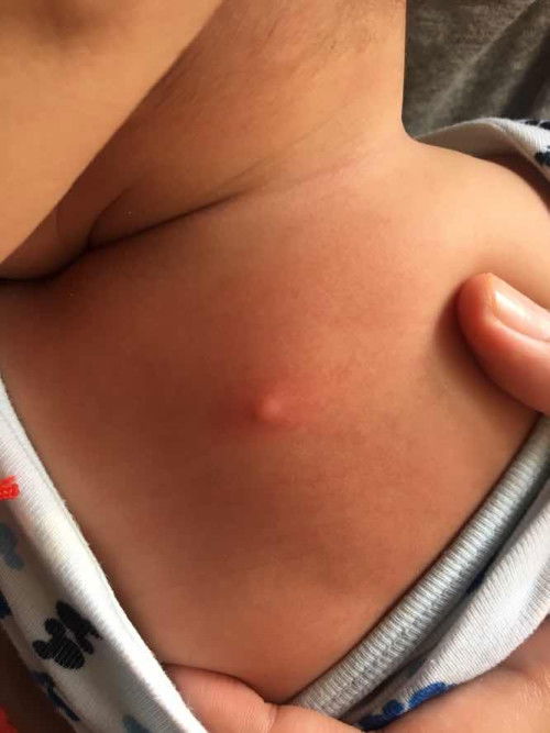 สอบถามหน่อยค่ะตุ่มแบบนี้คือตุ่มอะไรคะต้องไปหาหมอมั้ยคะแบบนี้