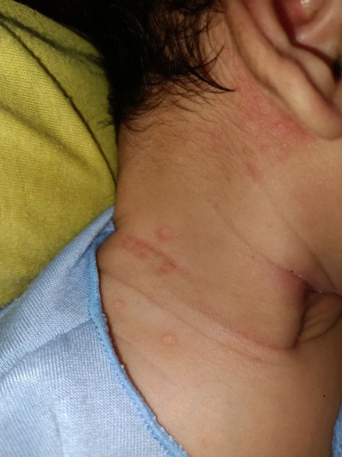 Ada merah merah lingkaran di bayi