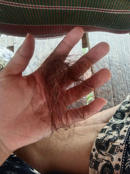 ผมร่วงหลังคลอดหนักมาก