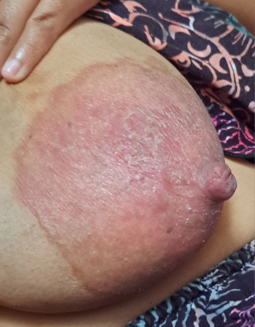 PD gatal, nyeri dan bersisik