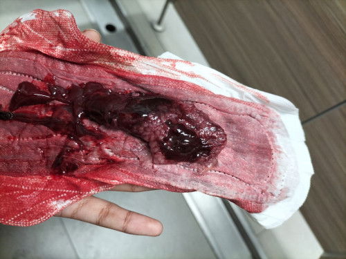 ขออนุญาตสอบถามคะท้อง11วิคแล้วเป็นแบบนี้เกิดจากไรคะ