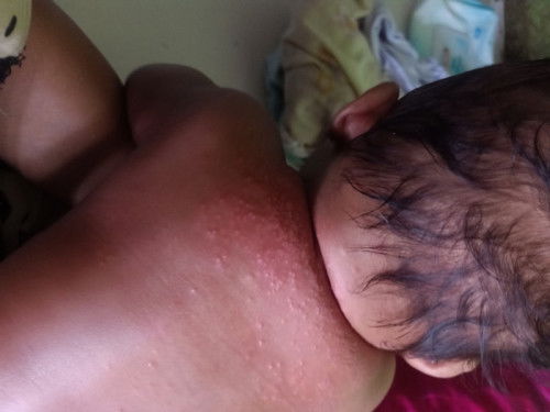 Bun tolong dong ini gimana yaa penyembuhan nya selain di bawa ke DSA