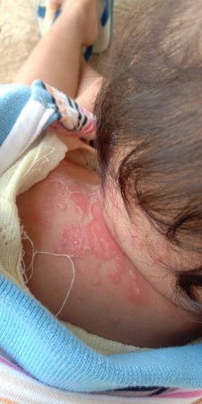 Biang keringat atau cacar air ?