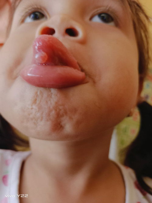 Benjolan bawah lidah