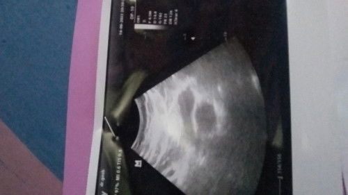 Garis 2 tapi gak ada janin