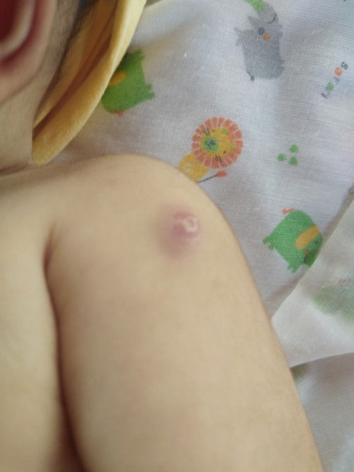 ฝีแตกอันตรายไหมค่ะแม่ๆ