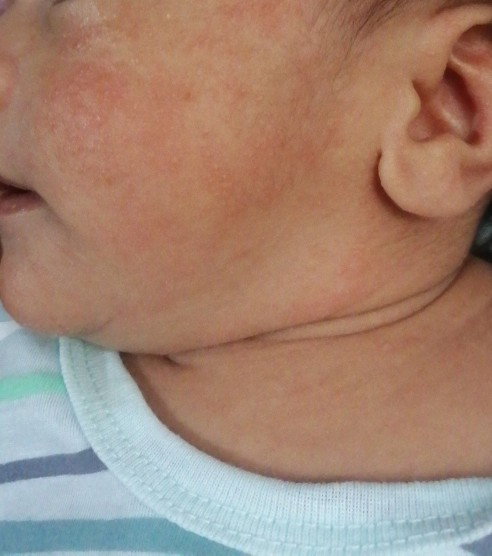 Baby acne or rashes??