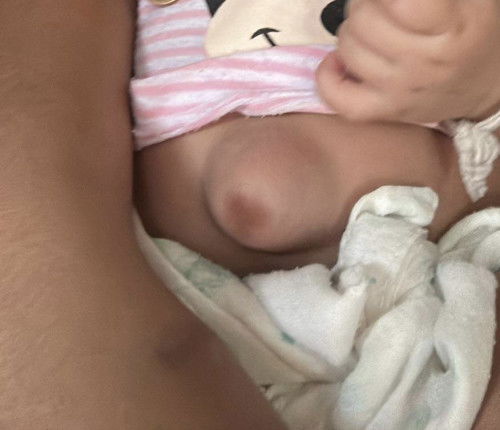 สะดือจุ่น ต้องทำยังไง