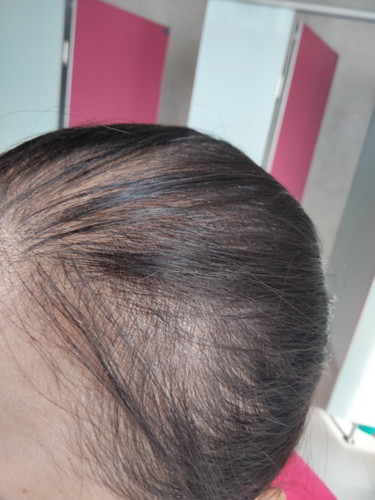 คลอดน้องได้5เดือน ผมร่วงหนักมาก