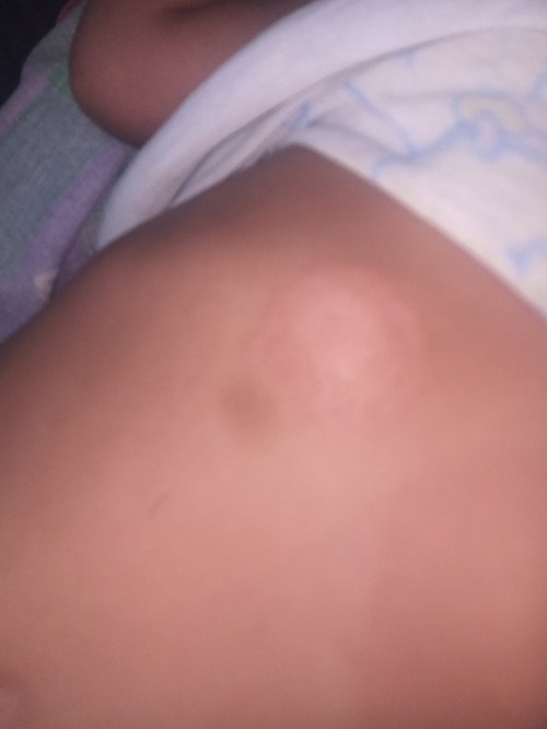 Bukol sa tyan 
(Soft tissue Mass)
sino po may same case Ng baby ko na 2yrs old