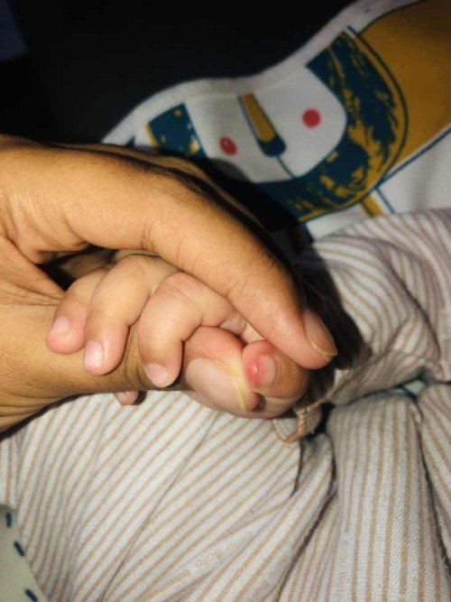 Luka pada bayi