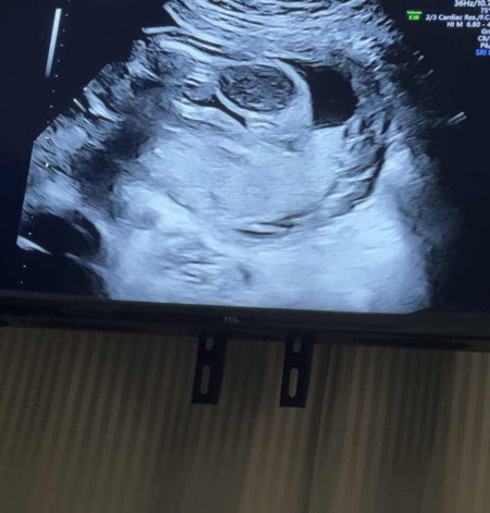 มีโอกาสจะได้เพศชายบ้างไหมคะ 23weeks ค่ะ