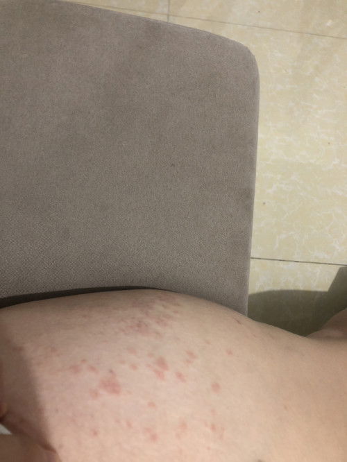 Rashes After Giving Birth